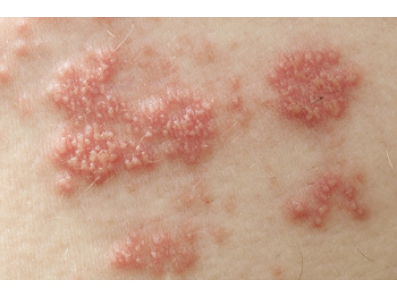 how long is shingles contagious after medication