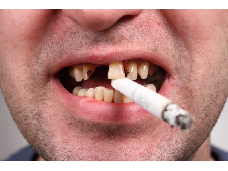 Effect of Smoking on Orthodontic Treatments