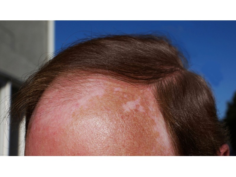 What Does A Tumor On Your Scalp Look Like