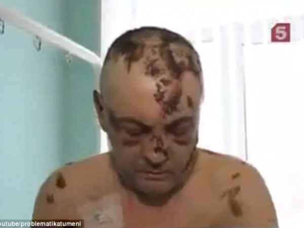 Joliet Krokodil Victims: Young, Middle-Class & Female, Doctor Says