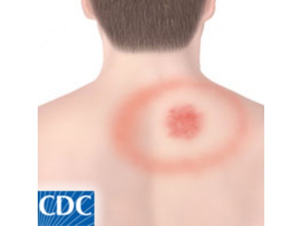 Health Watch: Look Out for Lyme Disease This Summer