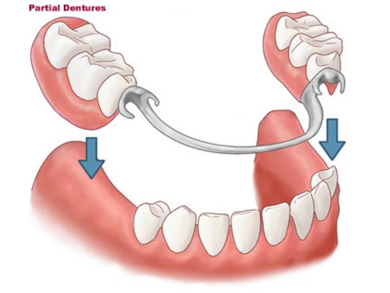 faqs-about-partial-dentures-lower-providence-pa-patch