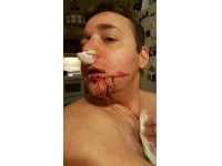 Slashing Victim Heard a 'Click' Before Cut Across Face