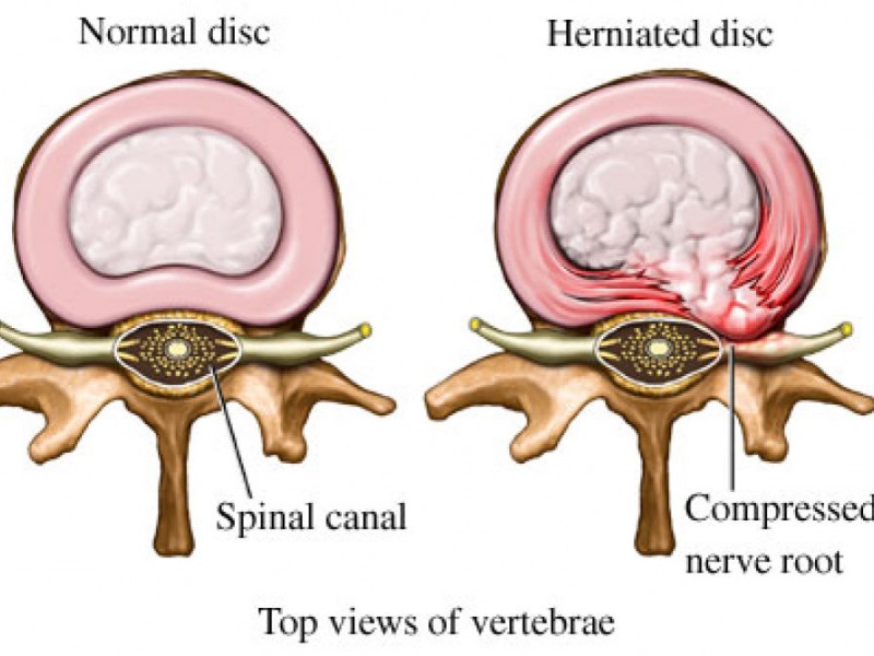 back-pain-it-s-probably-not-your-herniated-discs-long-beach-ny-patch