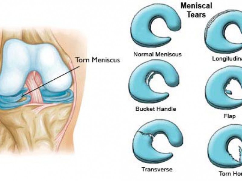 Ask the Orthopedic Surgeon What is the meniscus? Hopatcong, NJ Patch