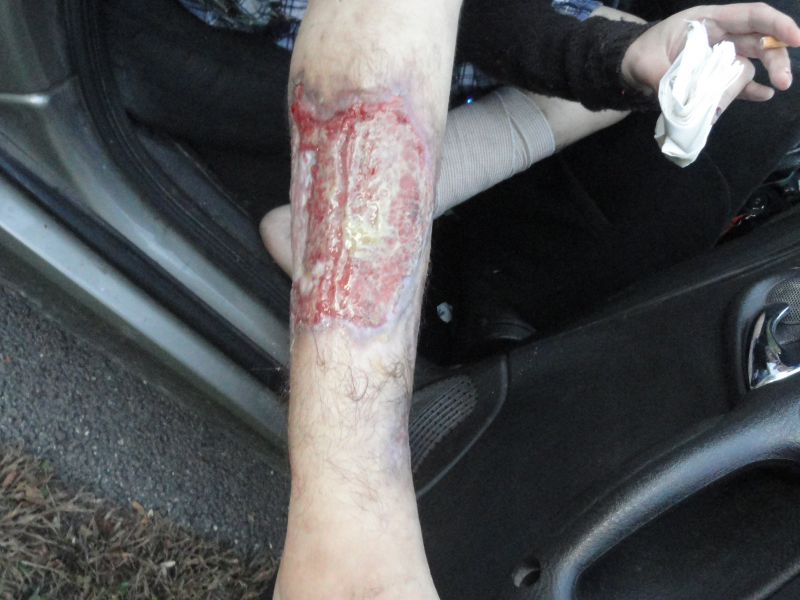 Joliet Women Who Claim to be 1st 'Crocodile' Drug Victims Go Public