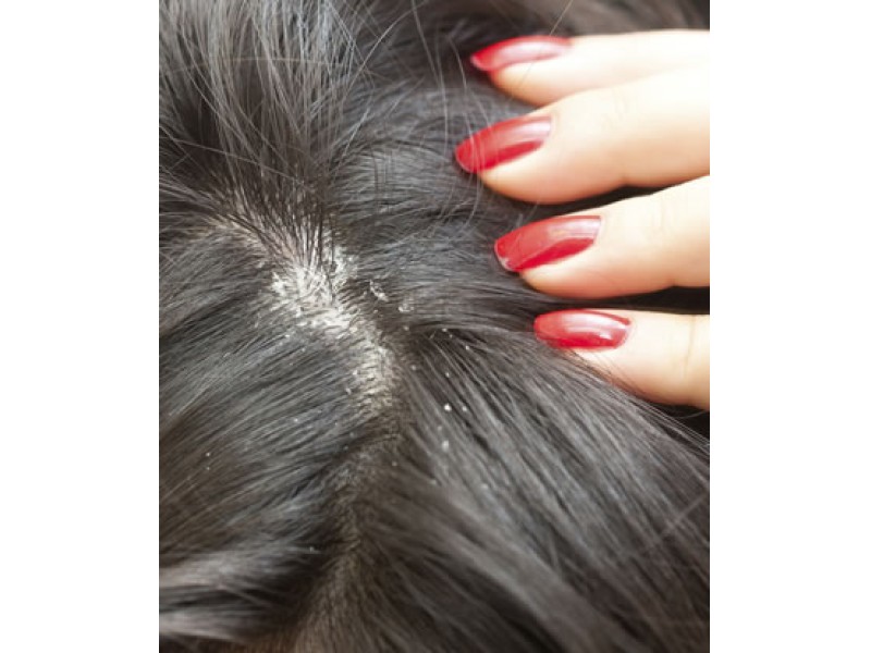 If You Suffer Those Embarrassing Flakes: Tips to Treat Dandruff ...